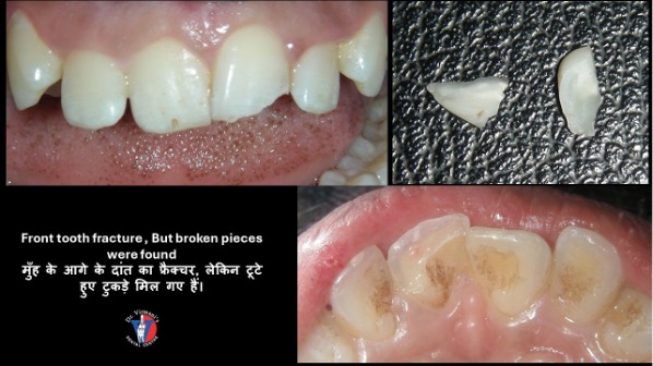 Brocken Pieces of Tooth Bonded together