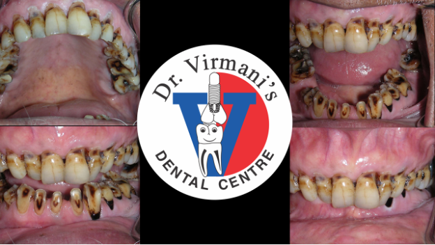 Worn out teeth made new & beautiful