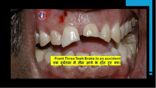 Front Three Teeth Broke in an accident