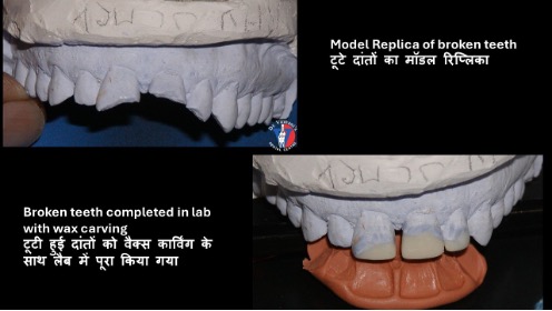 Model Replica of broken teeth