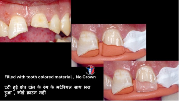 Filled with tooth colored material, No Crown