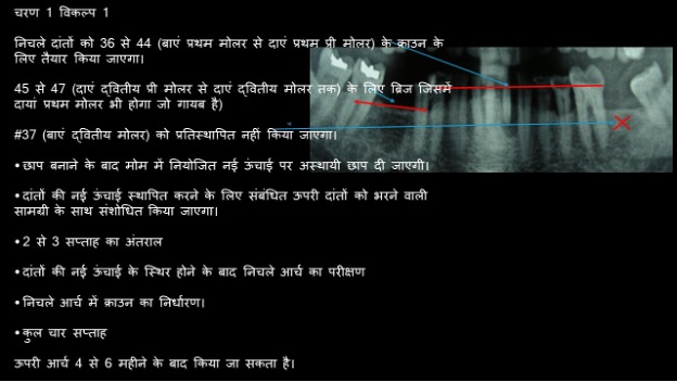 Worn out teeth made new & beautiful