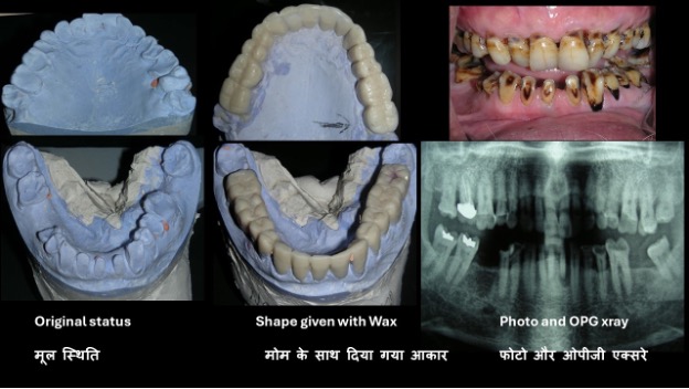 Worn out teeth made new & beautiful