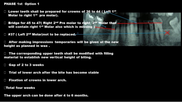 Worn out teeth made new & beautiful