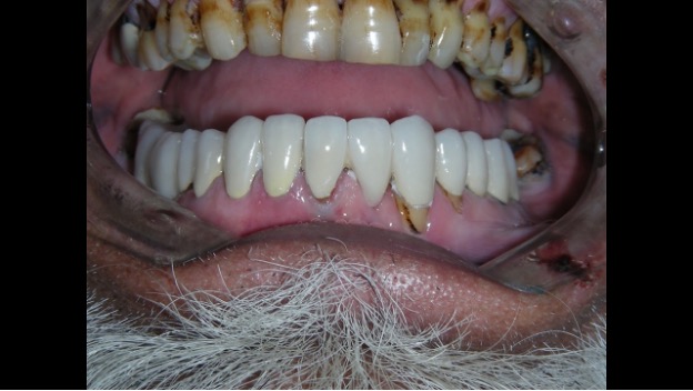 Worn out teeth made new & beautiful