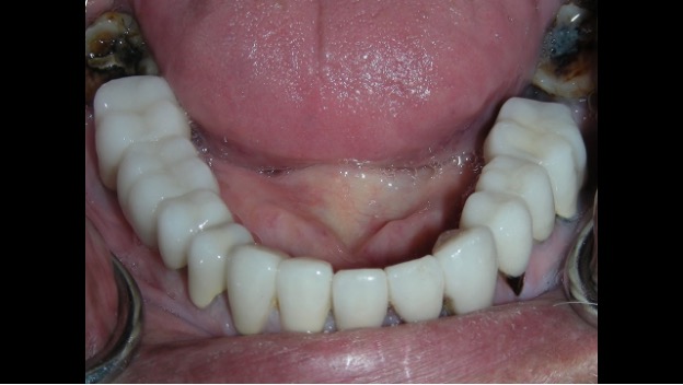 Worn out teeth made new & beautiful