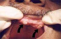 Grip balls fitted in the roots