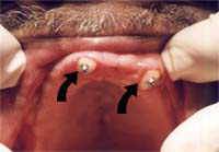 Two roots of upper jaw saved