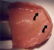 The grip rubbers are fitted in denture